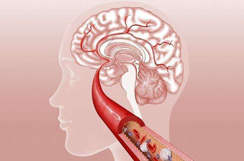 引發(fā)腦梗的因素有哪些