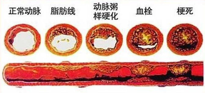 血栓在哪，病就在哪！該怎么清除血栓呢？